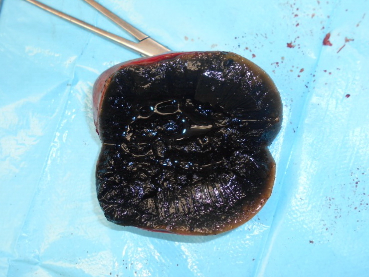 gallbladder1.jpg