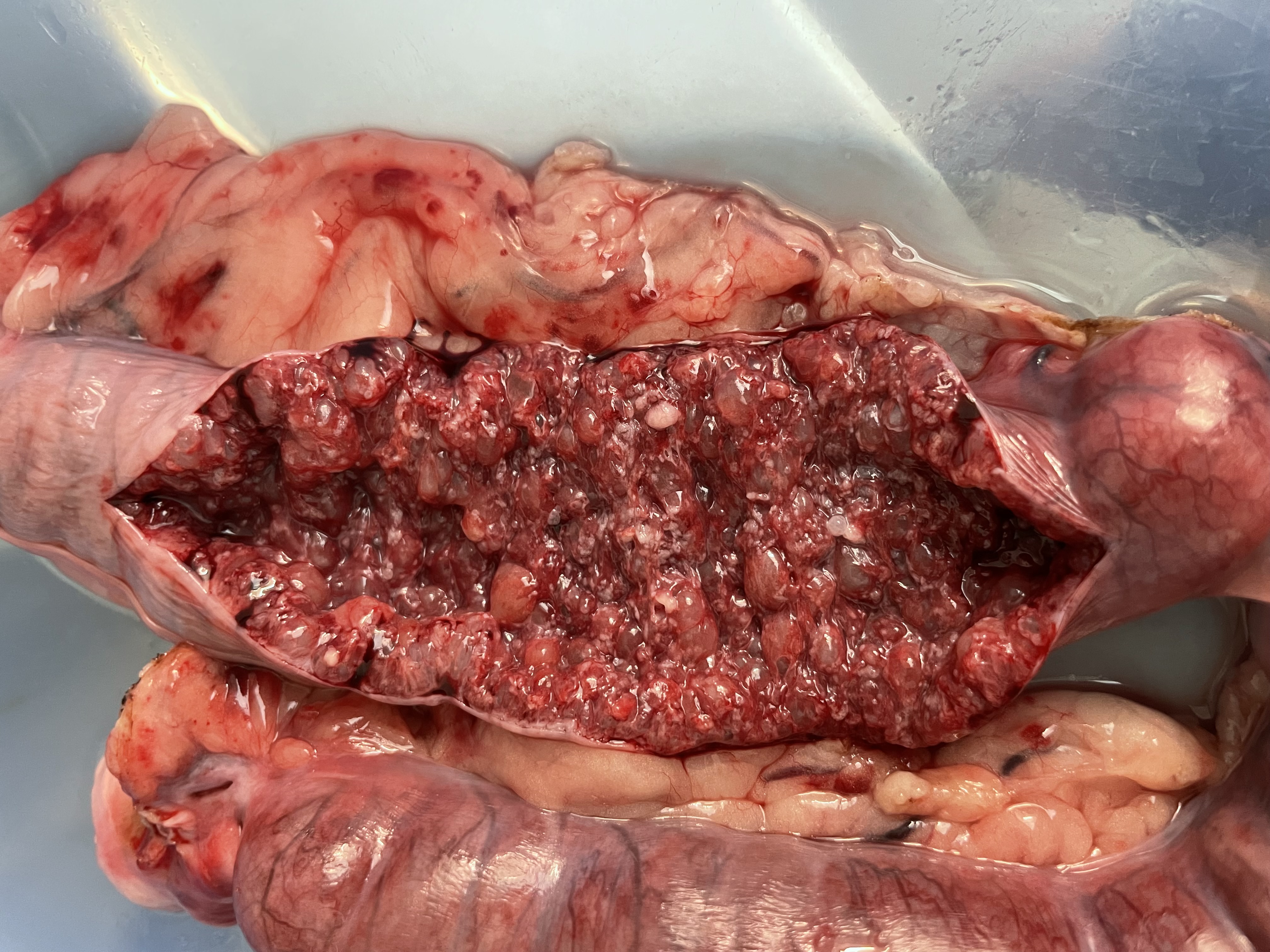 Cystická hyperplazie endometria 